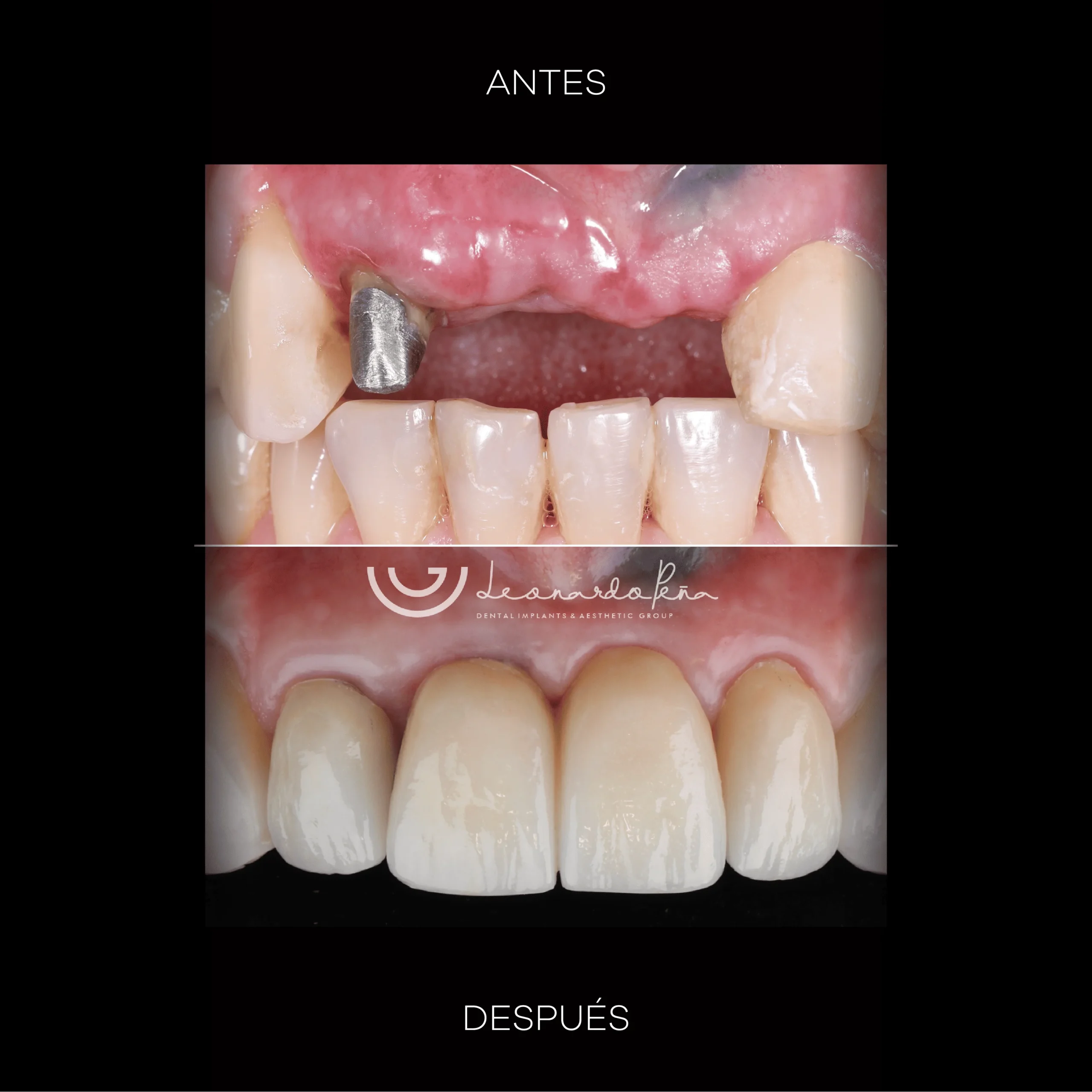 Implantes dentales