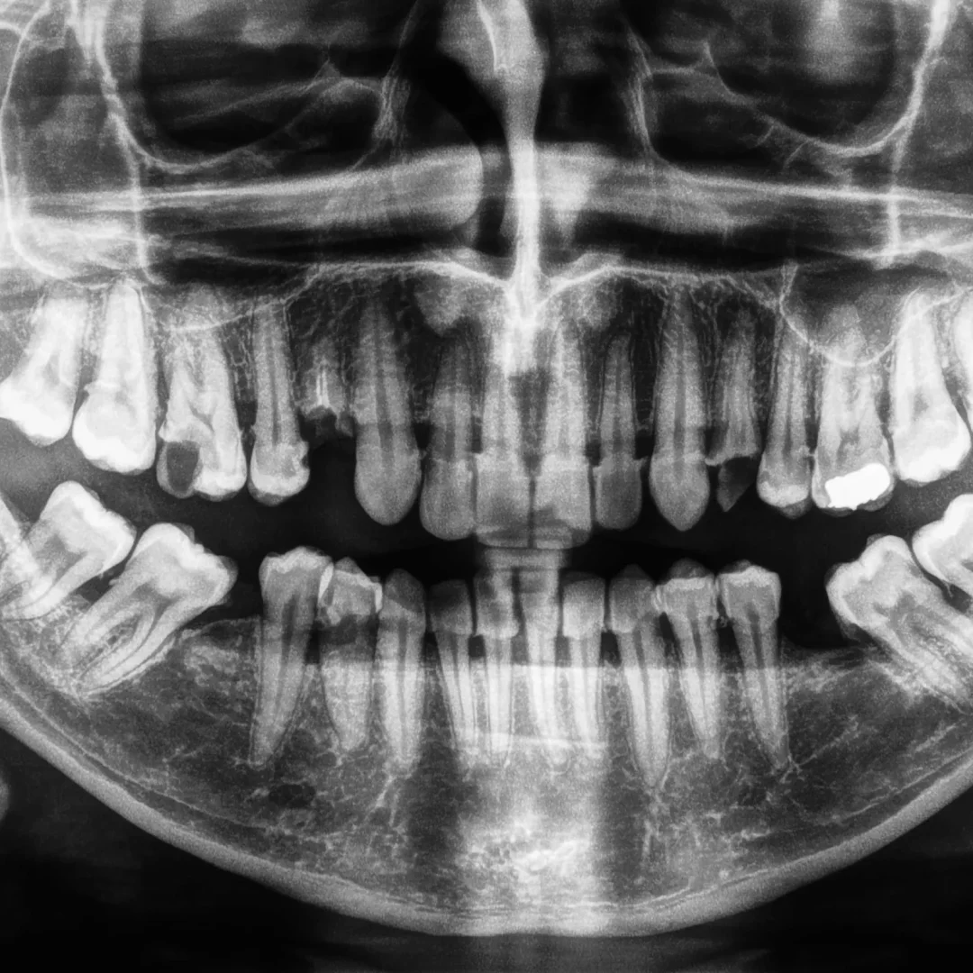 radiografia-de-dientes-humanos-en-blanco-y-negro-compressed (1)